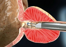 Фото: Ретроградная эякуляция после ТУР